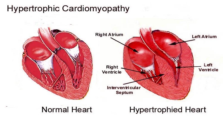 Normal Heart