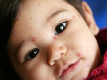  Rubella eliminated from North and South America, officials declare