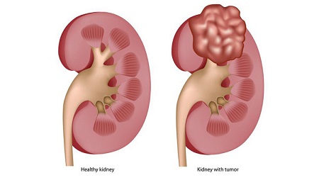 Kidney