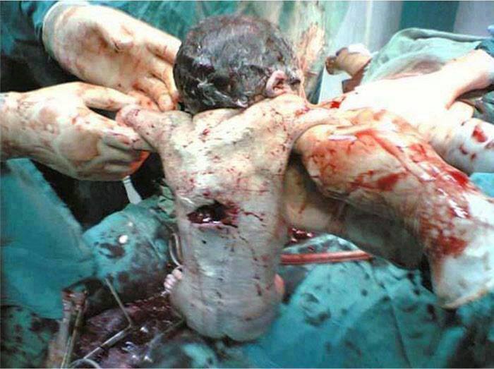 Palestinian embryo martyred with his mother