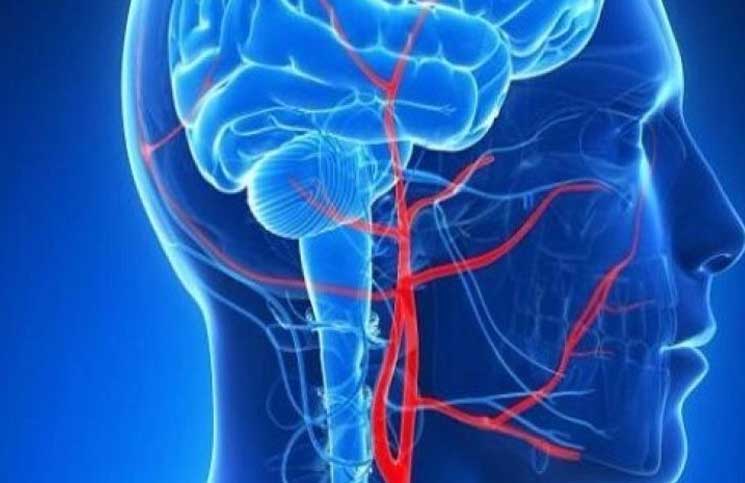 علماء يابانيون يكتشفون آلية لوقف نزيف المخ المميت