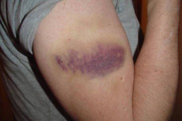 البقع الزرقاء على الجسم.. في هذه الحالة تعني أنّك مصاب بالسرطان!