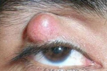 كيف يتكوّن الكيس الدّهني على العين؟!