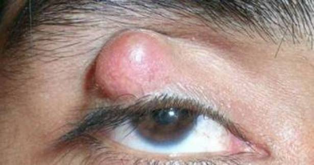 كيف يتكوّن الكيس الدّهني على العين؟!
