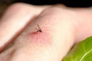 هكذا توقف الحكة الناتجة عن لدغات البعوض!