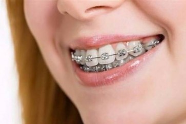 تقويم الأسنان متى يكون ضرورياً؟