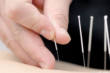 الوخز بالإبر لـخسارة الوزن بسرعة فائقة!