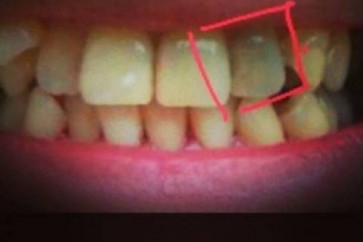 هل تعرفون أنّ الضرس يموت؟ هذه أعراضه وعلاجاته