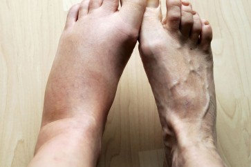 8 أمراض خطرة تكشفها لكِ قدماكِ