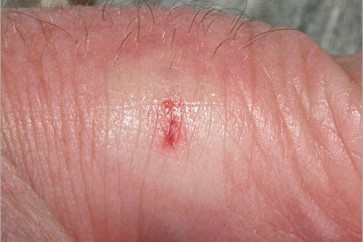 كيف تعالجون فوراً لسعات الحشرات على اختلافها!