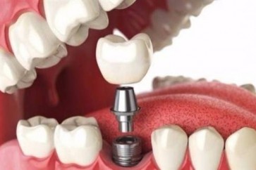 نصائح مهمة قبل إجراء جراحة زراعة الأسنان!