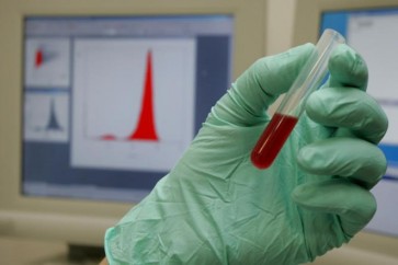اختبار الدم مهم في التشخيص المبكر