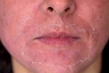 احذروا الاحمرار الشَّديد للوجه.. هذا ما عليكم فعله!