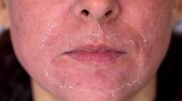 احذروا الاحمرار الشَّديد للوجه.. هذا ما عليكم فعله!