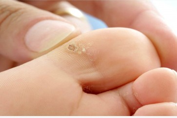 كيفية التخلّص من مسامير القدم بواسطة مكوّنات طبيعية!