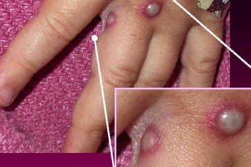 الولايات المتحدة سجلت عشرات الإصابات سنة 2003