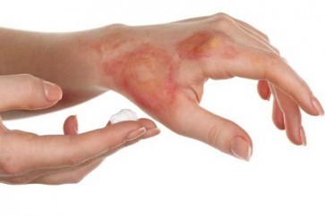 من البيض إلى الثلج.. 5 طرق خاطئة لعلاج الحروق المنزلية