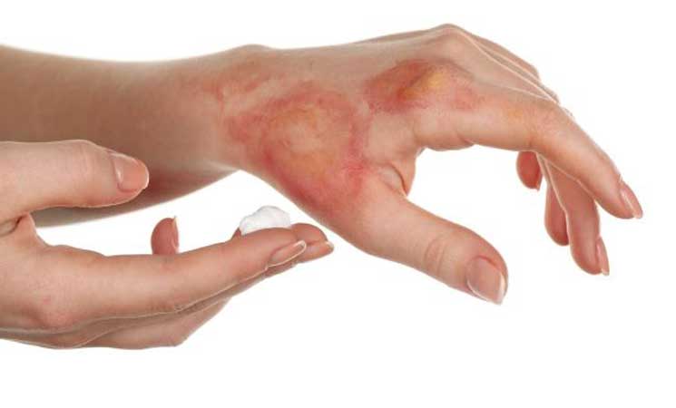 من البيض إلى الثلج.. 5 طرق خاطئة لعلاج الحروق المنزلية