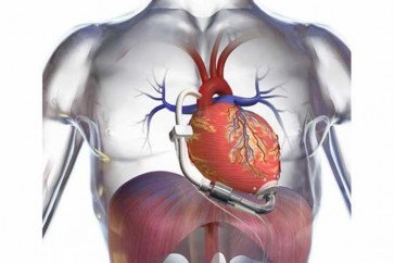 بشرى لمرضى القلب… أول قلب من السليكون