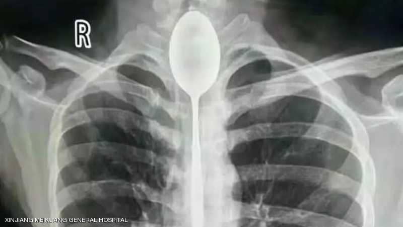 صيني ابتلع ملعقة وحدث ما لا يمكن تصوره