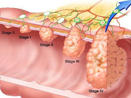 العلاج الكيميائي بعد استئصال سرطان القولون يزيد فرص النجاة
